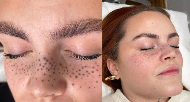 Woman's freckle tattoo on face goes badly wrong