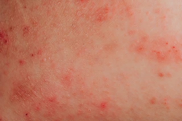 <p>PansLaos / Getty Images </p> Contact dermatitis