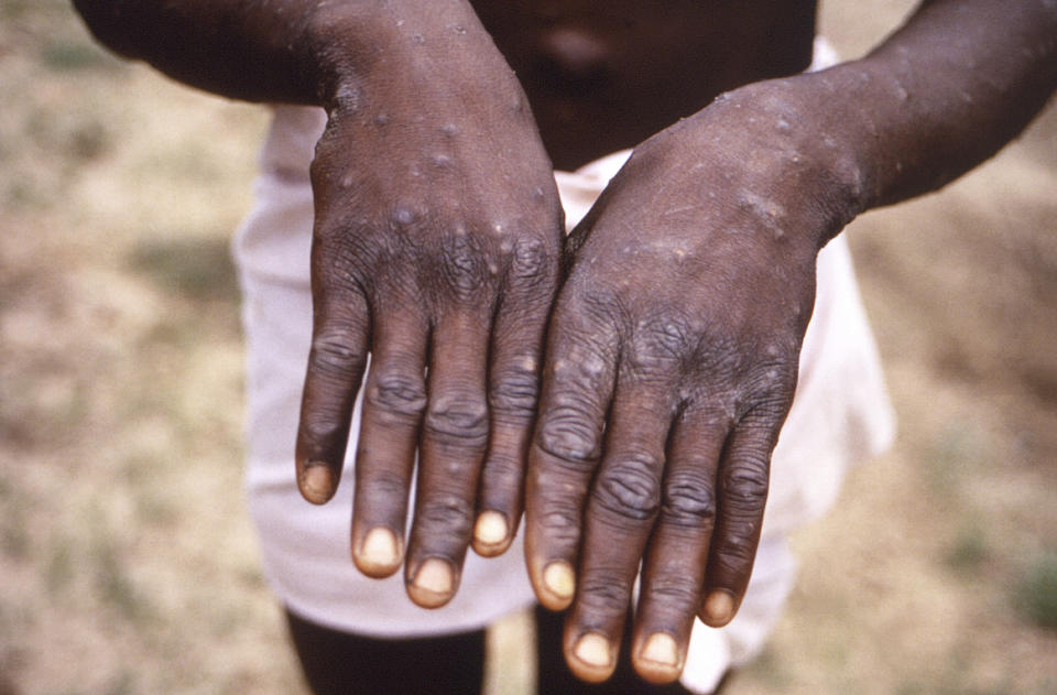 FILE - This 1997 image provided by the CDC during an investigation into an outbreak of monkeypox, which took place in the Democratic Republic of the Congo (DRC), formerly Zaire, and depicts the dorsal surfaces of the hands of a monkeypox case patient, who was displaying the appearance of the characteristic rash during its recuperative stage. The World Health Organization is creating a new vaccine-sharing mechanism to stop the spiraling outbreak of monkeypox in more than 30 countries beyond Africa. (CDC via AP, File)