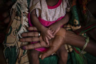 Abeba Gebru, 37, from the village of Getskimilesley, holds the hands of her malnourished daughter, Tigsti Mahderekal, 20 days old, in the treatment tent of a medical clinic in the town of Abi Adi, in the Tigray region of northern Ethiopia, on Tuesday, May 11, 2021. She had the baby at home and walked 12 days to get the famished child to a clinic in the northern Ethiopian region of Tigray. “She survived because I held her close to my womb and kept hiding during the exhausting journey." (AP Photo/Ben Curtis)