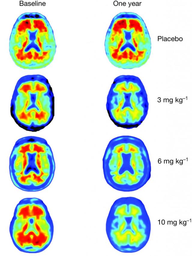 The Amyloid State of Proteins in Human Diseases: Cell