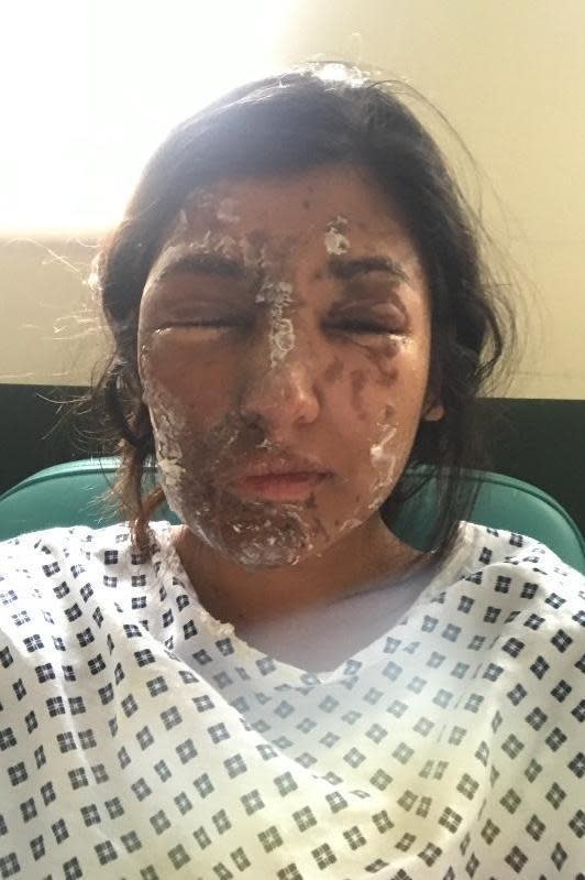 Scarring: The acid was thrown across her face and body (GoFundMe)