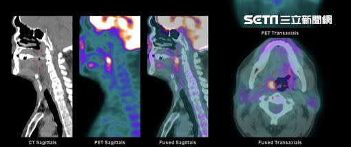 亮點是扁桃腺癌的正子攝影影像。（圖／南投醫院提供）