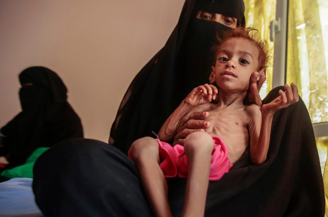 <p>A malnourished child arrives for treatment at the Aslam Health Centre, in Hajjah, Yemen</p> (AP)