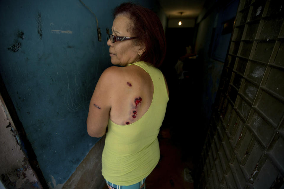 Carmen Marcano, a Cotiza neighborhood resident, shows her wounds caused by rubber bullets fired by Venezuelan Bolivarian National Guardsmen during a protest, a day prior, in response to the arrest of National Guardsmen who mounted an uprising against President Nicolas Maduro, in Caracas, Venezuela, Tuesday, Jan. 22, 2019. Working class neighborhoods in Venezuela's capital sifted through charred rubble and smoldering trash on Tuesday, after isolated protests erupted in the streets Monday. (AP Photo/Fernando Llano)