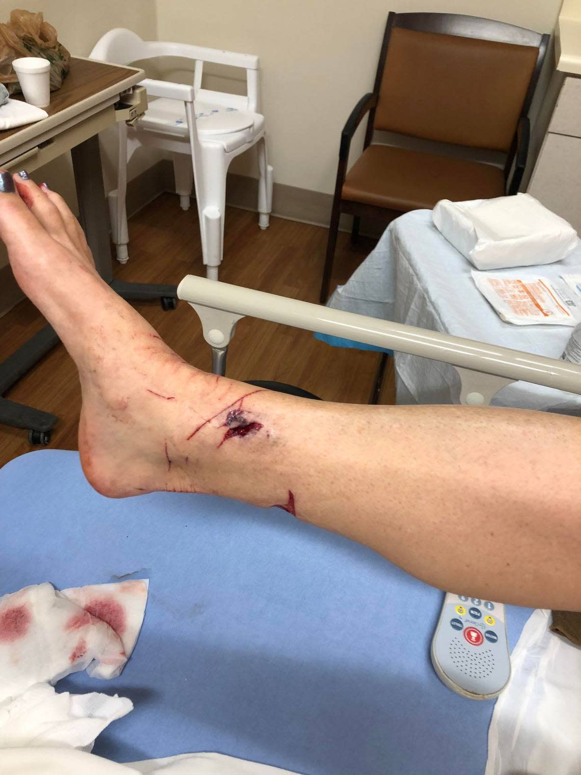 Barabara Ard, vacationing on Hilton Head Island from N.C., was bitten twice by a raccoon during Labor Day weekend and received more than 20 stitches after the attack.