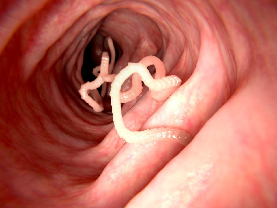 A man’s brain tapeworm from bad bacon is the focus of a new medical study. Juan GÃÂ¤rtner – stock.adobe.com