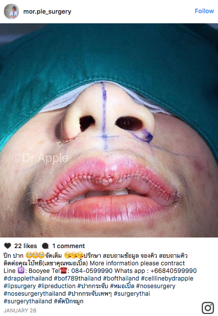 Lip reduction surgery, which involves cutting the lips to reduce their size, is attracting attention on social media.