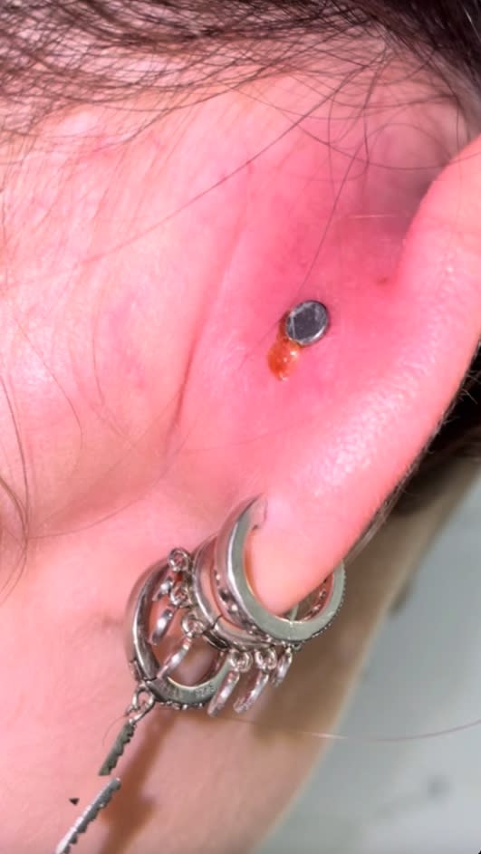 ear piercing wound pictured