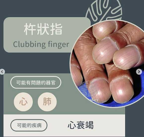 Fingernails see health warning signs.  (Picture / flip from IG / derma.royce)