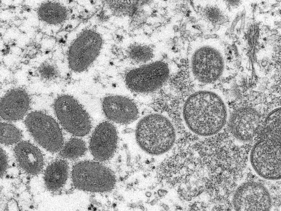 This electron microscopic image depicts a monkeypox virion, obtained from a clinical sample associated with a 2003 prairie dog outbreak.  (Cynthia S. Goldsmith/CDC - image credit)