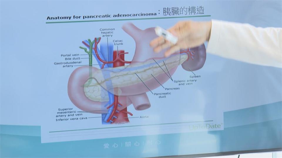 陪先生健檢揪出癌王　女早期發現胰臟癌免化療