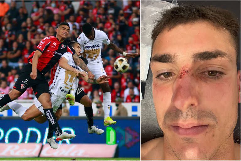 El delantero Juan Dinenno mostró cómo le quedó el rostro tras el golpe que recibió de Anderson Santamaría.