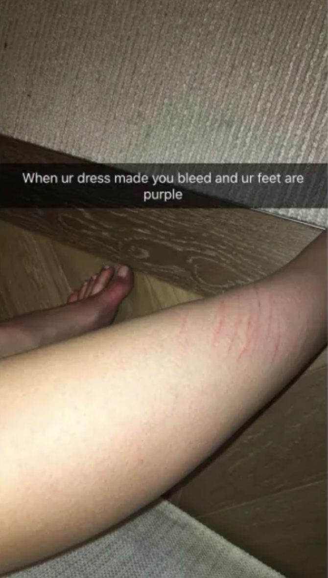 Kylie's leg with red marks, and a caption about discomfort from a dress