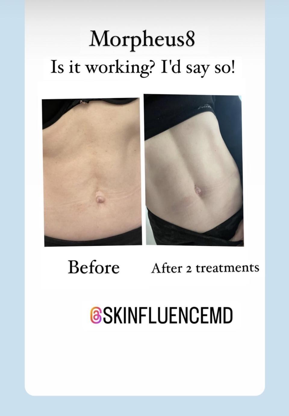 microneedling body before and after