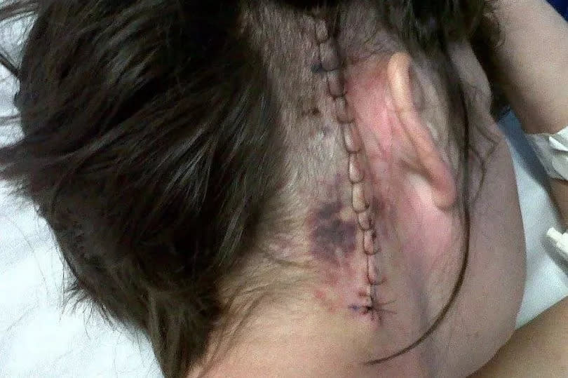 Clare Rapley's brain surgery scar after her operation