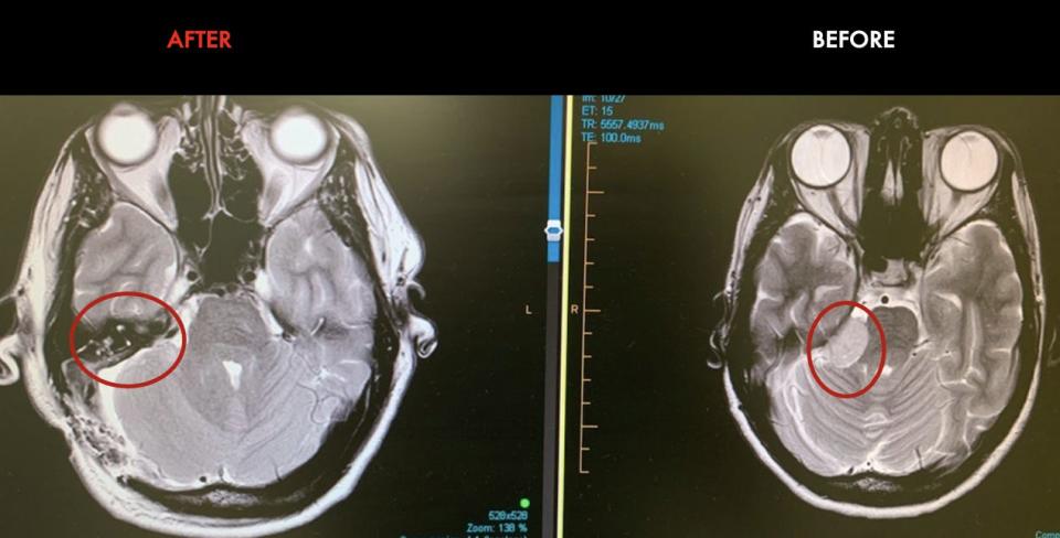 MRI image of Andreea Vanacker's brain tumor