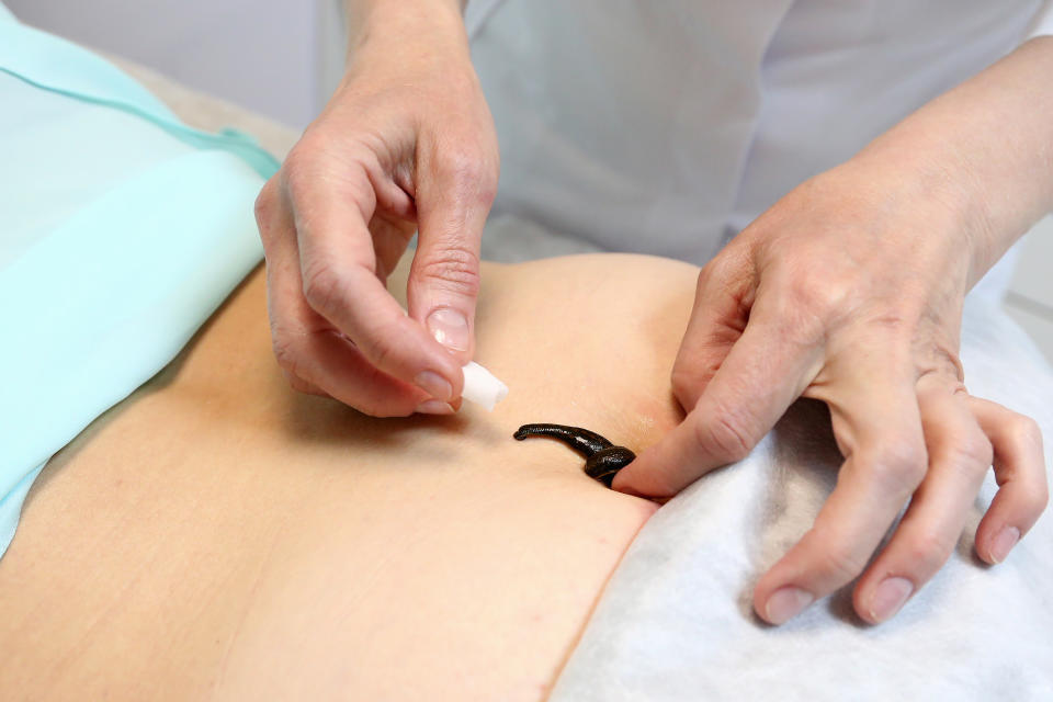 An image of a leech being placed on a woman's belly by a medical professional