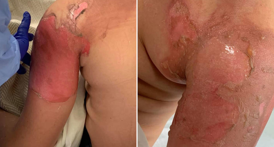 Billy Oliver's burned shoulder. The 11-year-old's mum said his friend poured boiling water on him as part of the hot water challenge.