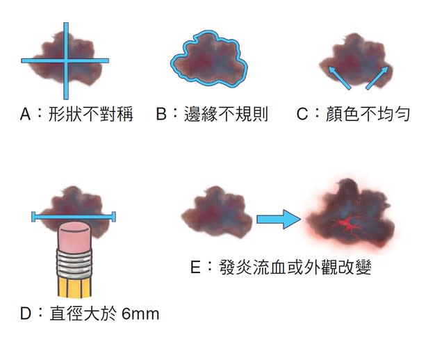 皮膚黑痣、皮膚癌的自我檢查方法