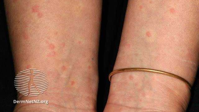 cholinergic urticaria