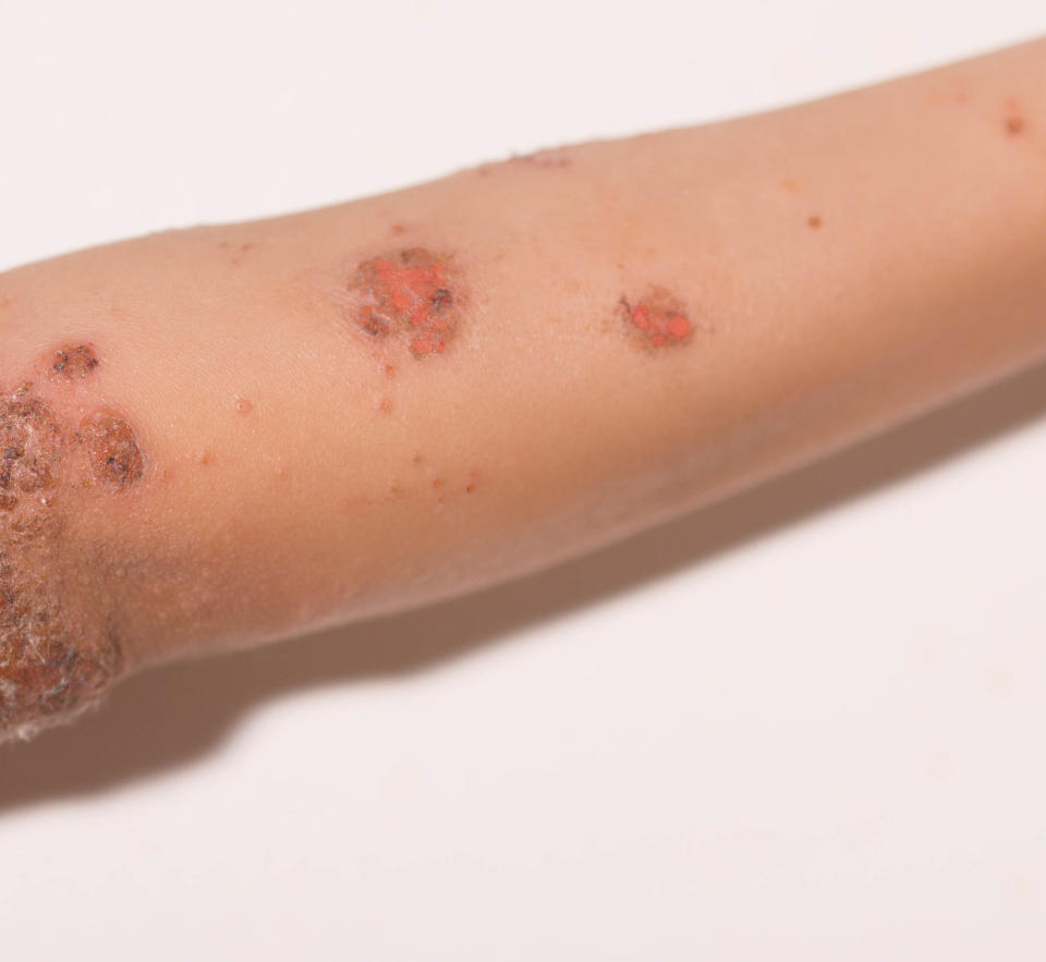 Impetigo (Matthew Roberge / Getty Images)