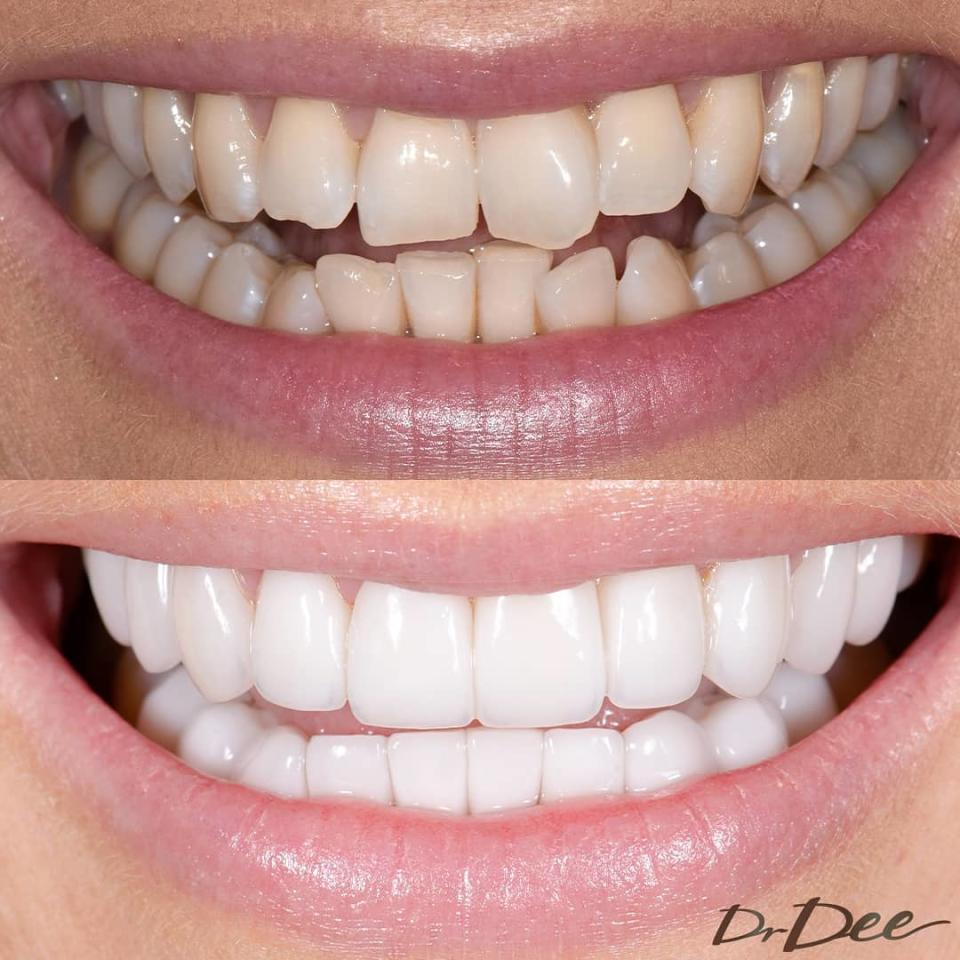 Jo's teeth before (top) and after her dental makeover. Photo: Instagram/jotodd9.