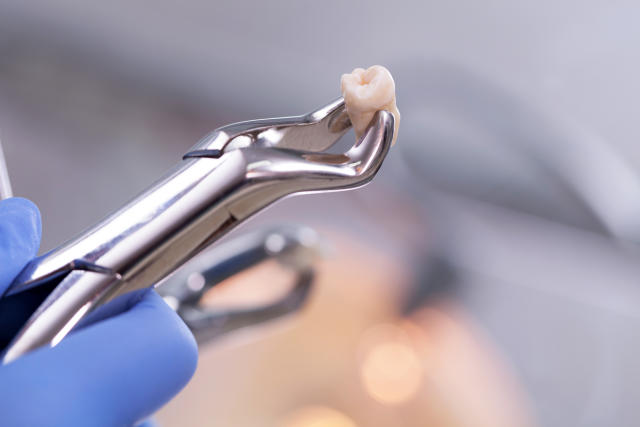 L'extraction des dents de sagesse est souvent recommandée par les dentistes