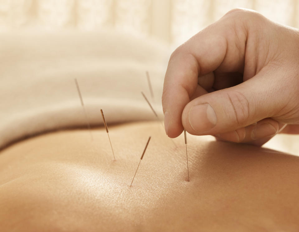 Acupuncture (Getty Images)