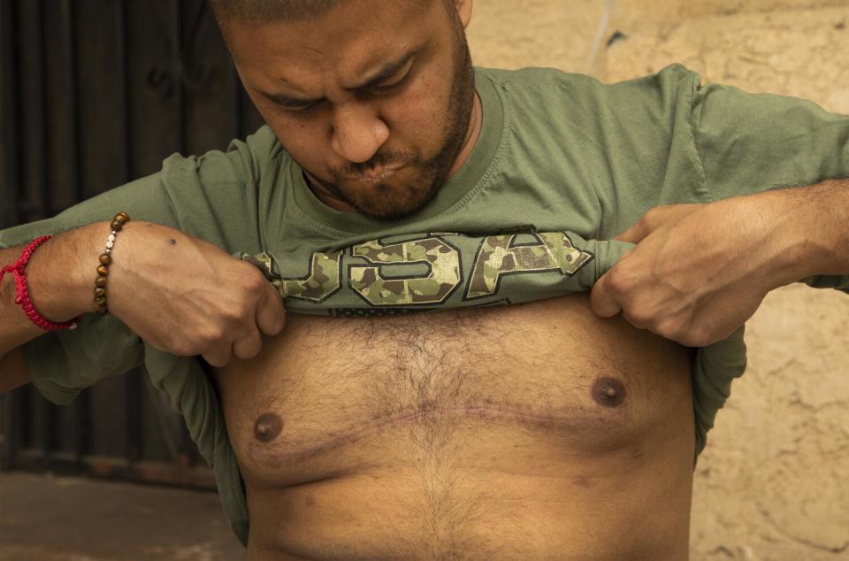 Dennys Rene Rivas Williams lifts his shirt to show the scar of a double lung transplant.