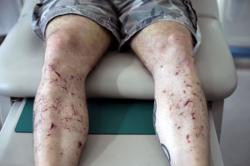 FILE PHOTO: Wounds are seen on the legs of Shady Rizk, as he visits plastic surgeon Dr. Joe Baroud, who offers his services for free to people injured by a massive explosion at the port area