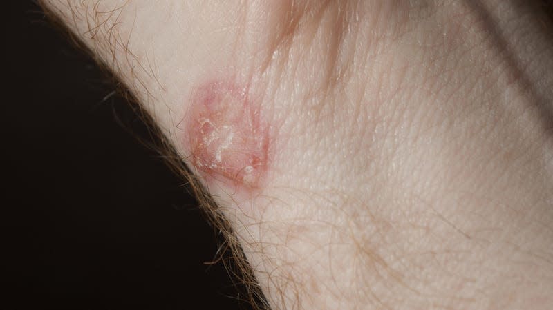 A mild ringworm infection.