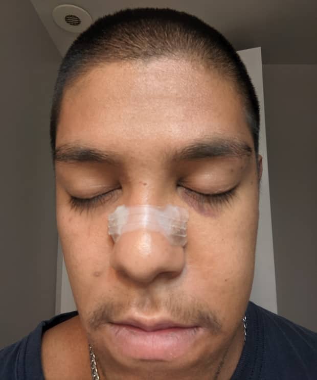 David Gomez, 24, was knocked unconscious and suffered a broken nose, cheekbone and orbital bone, an injury to his hip and a concussion in an attack on Toronto Island on June 5, according to a crowdfunding campaign that has raised nearly $49,000 for him. (Submitted by David Gomez - image credit)