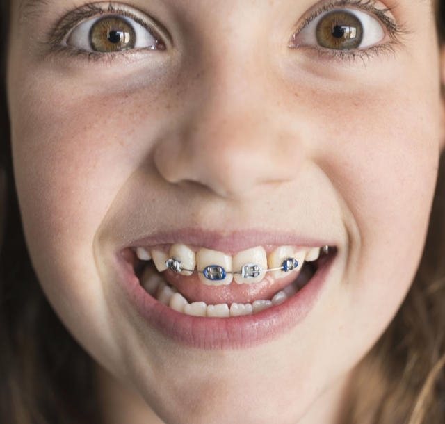 Make fake braces with earring backs and a rubber band