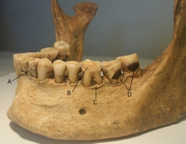 <span class="caption">Dental pathology and wear on the mandible of a medieval individual. A: calculus; B) heavy/angled wear; C) periodontal disease; D) cavities.</span> <span class="attribution"><span class="source">Ian Towle</span>, <span class="license">Author provided</span></span>