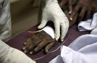 <p>A Pakistani patient suffering from a heatstroke receives treatment at a local hospital in Karachi, Pakistan, June 24, 2015. (AP Photo/Shakil Adil) </p>