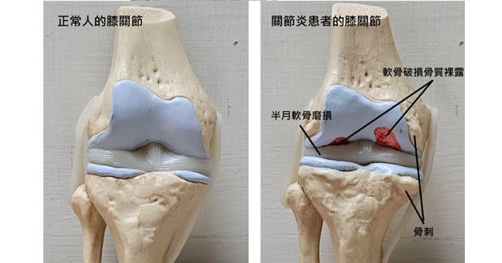 圖二：退化性關節炎的患者，股骨遠端的軟骨易產生破損(右圖)。（圖片提供／台灣復健醫學會）