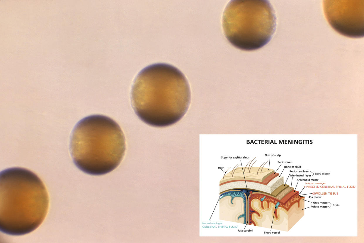 Microscopic view of five colonies of Group-B Neisseria meningitidis bacteria.