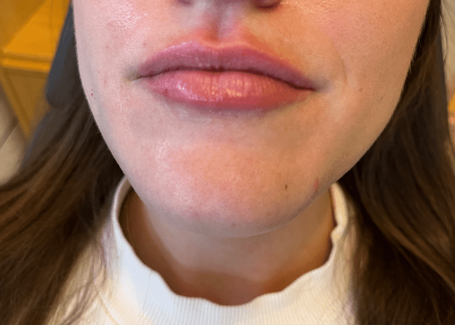 <p>Byrdie</p> Immediately after lip filler, minimal swelling and needle pockmarks can be expected.