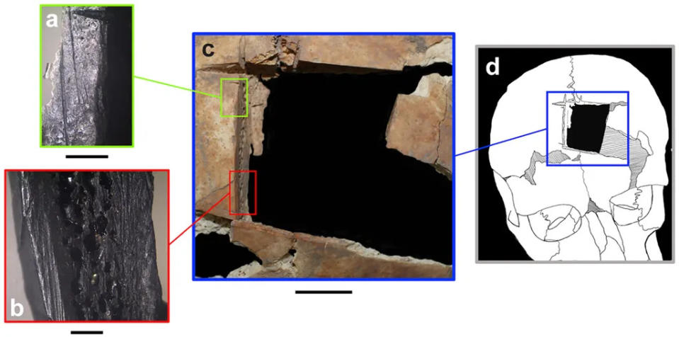Detalhes da trepanação realizada há 4 mil anos: em (a) e (b), um zoom é aplicado nos cortes, e no (c), uma visão completa da perfuração (Imagem: Kalisher et al./PLOS One)