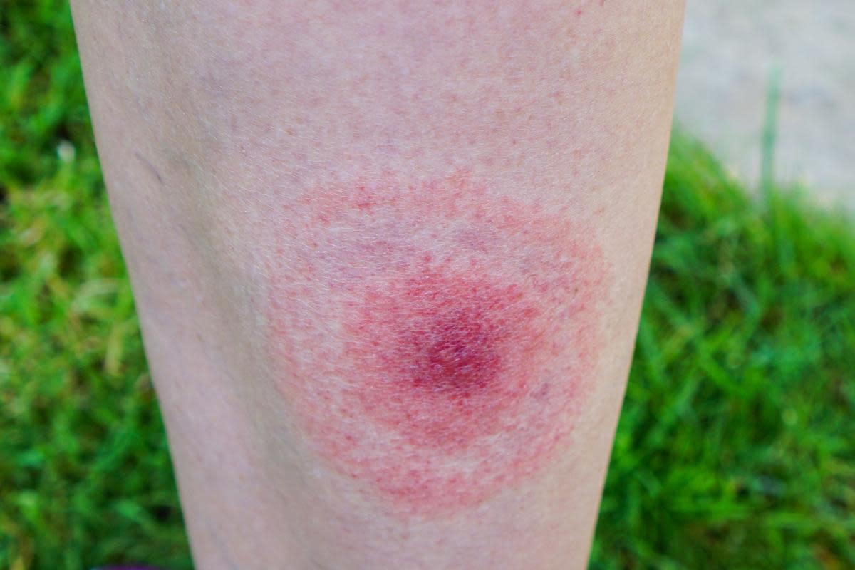 What is Lyme disease? What we know including symptoms and when to see a GP