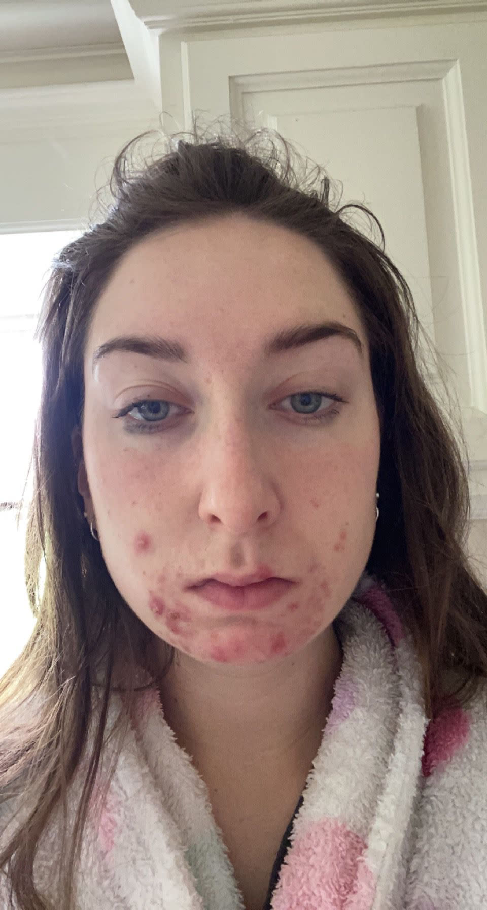 Kate found a solution for her acne using data and artificial intelligence