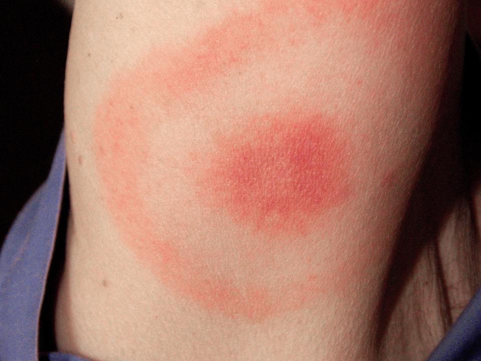 lyme disease rash bullseye