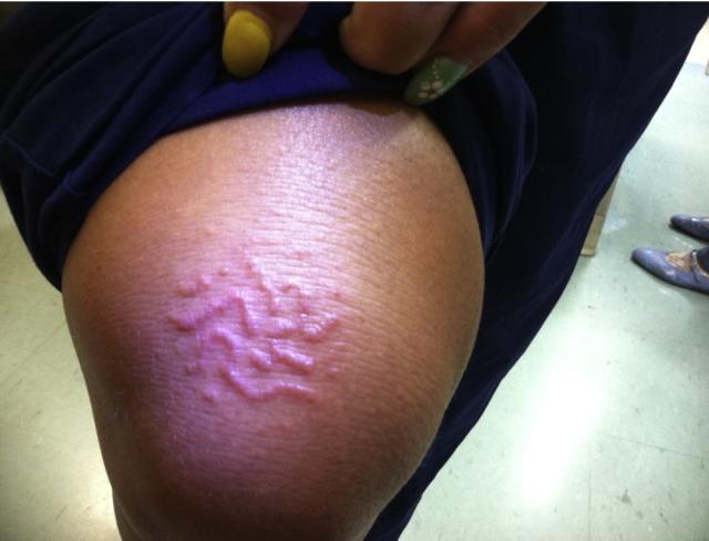 Case study: Teen's rash discovered to be worms