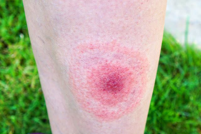 <p>Getty</p> The telltale "bullseye" rash that often signifies the bite of an infected tick.