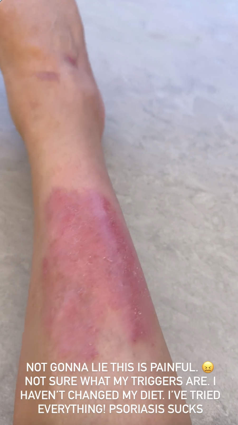 kim kardashian reveals painful psoriasis on her leg