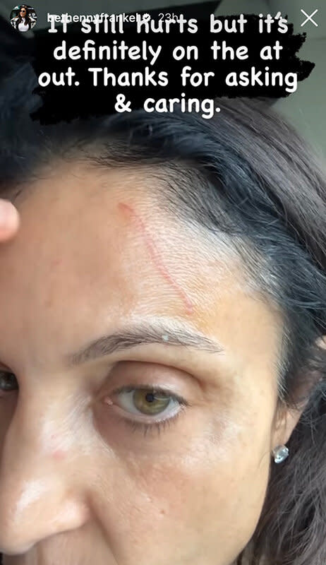 Bethenny Frankel Scar Embed