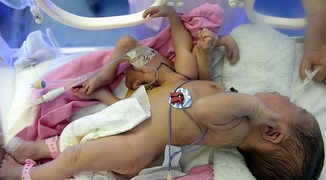 A baby boy has been born with four arms and four legs. Photo: Imaginechina/Corbis