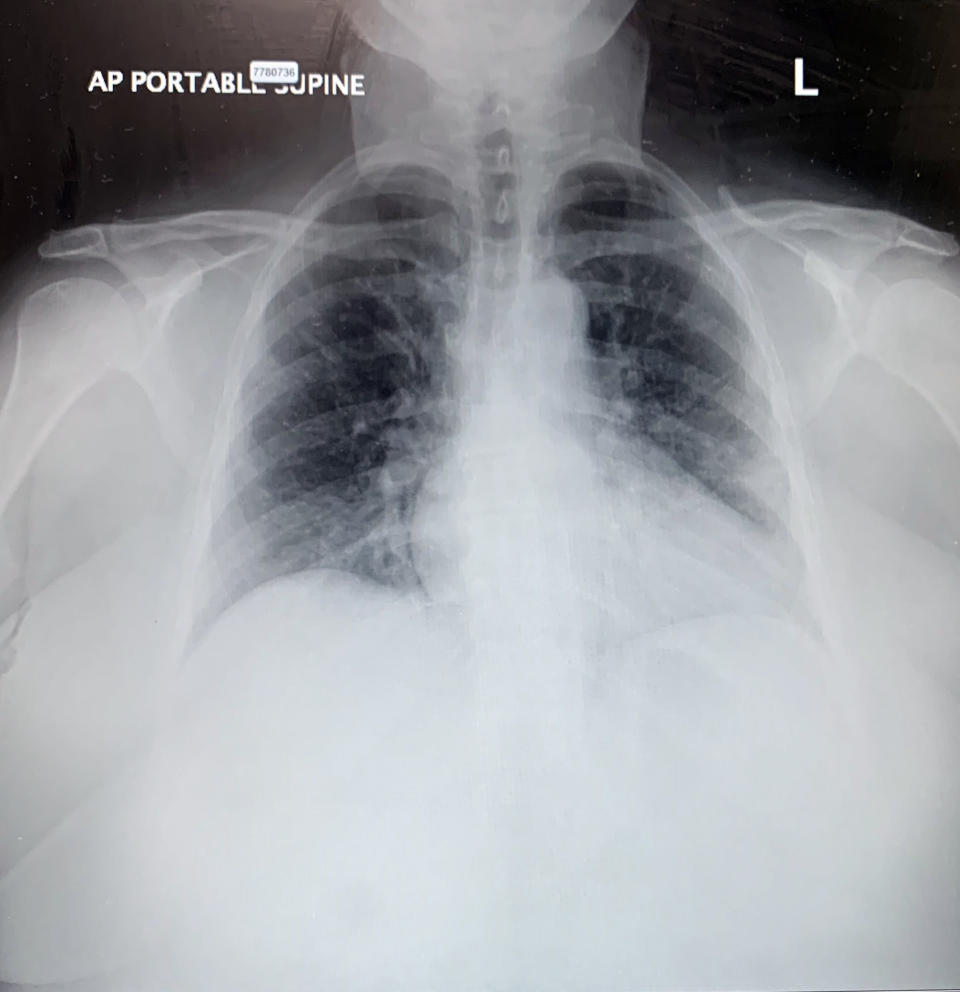 Image: Claudia Garcenot X-ray. (Mount Sinai Hospital System)