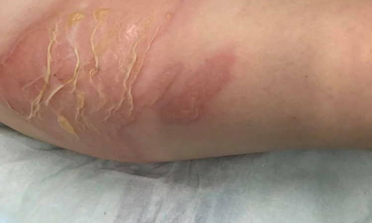 The four-year-old’s right upper thigh was burned when an out-of-date hot water bottle split open. Source: Harmony Arrowsmith